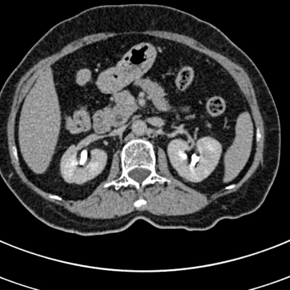 File:Normal CT split bolus study of the renal tract (Radiopaedia 48631-53634 Axial split bolus 59).jpg
