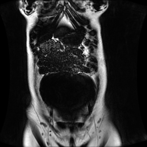 Normal MRI abdomen in pregnancy (Radiopaedia 88001-104541 N 38).jpg