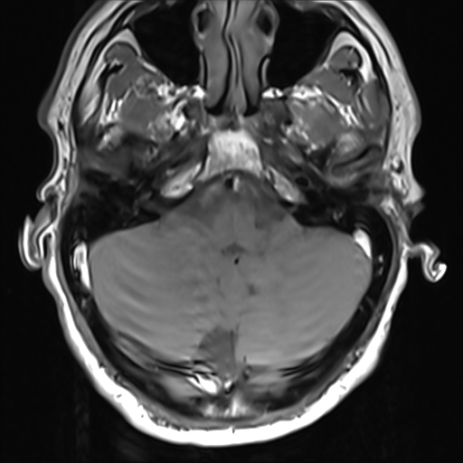 File:Normal MRI cervical spine (infection protocol) (Radiopaedia 53916-60039 Axial 1).png
