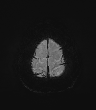 Normal MRI internal auditory canal (Radiopaedia 41613-44525 Axial SWI MIP 75).png