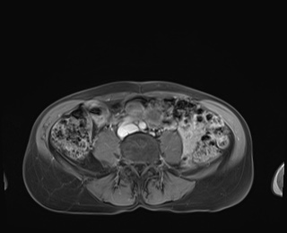 Normal adrenal glands MRI (Radiopaedia 82017-96004 M 70).jpg