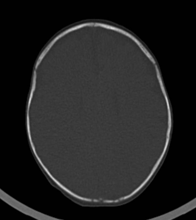Normal brain CT - 2-month-old (Radiopaedia 53369-59350 Axial bone window 22).jpg