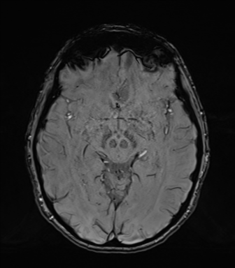 Normal brain MRI (TLE protocol) (Radiopaedia 40748-43405 Axial SWI 39).png