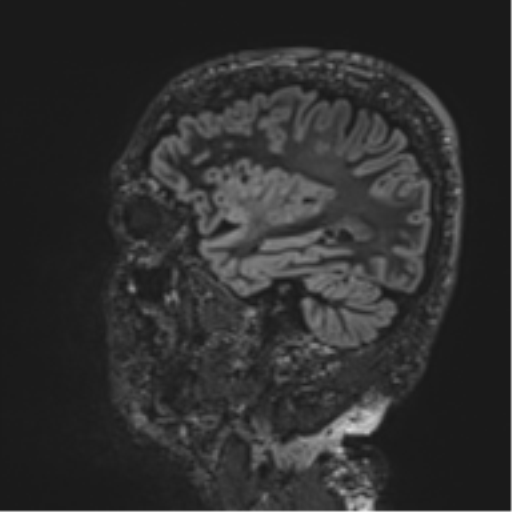 Normal brain MRI (non-focal epilepsy protocol) (Radiopaedia 53917-60040 Sagittal DIR 20).png
