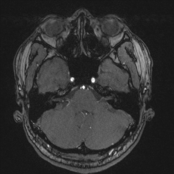 Normal brain MRI including MRA (Radiopaedia 48748-53763 Axial MRA 44).jpg