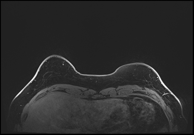 Normal breast MRI - dense breasts (Radiopaedia 80454-93850 C 25).jpg