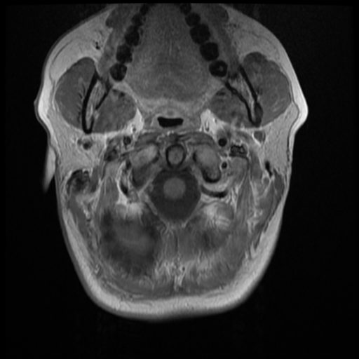 File:Normal cervical and thoracic spine MRI (Radiopaedia 35630-37156 Axial T1 C+ 31).png