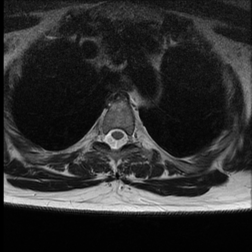 File:Normal cervical and thoracic spine MRI (Radiopaedia 35630-37156 H 34).png