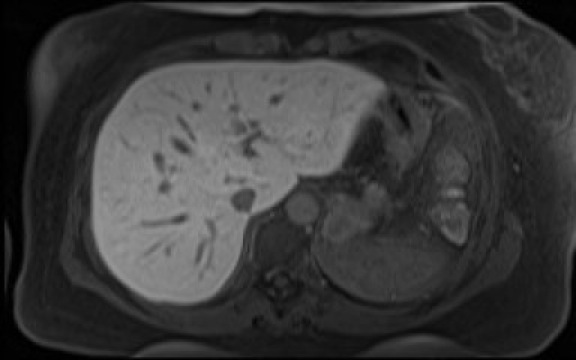 File:Normal hepatobiliary phase liver MRI (Radiopaedia 58968-66230 A 29).jpg