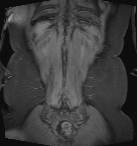 File:Normal hepatobiliary phase liver MRI (Radiopaedia 58968-66230 B 2).jpg