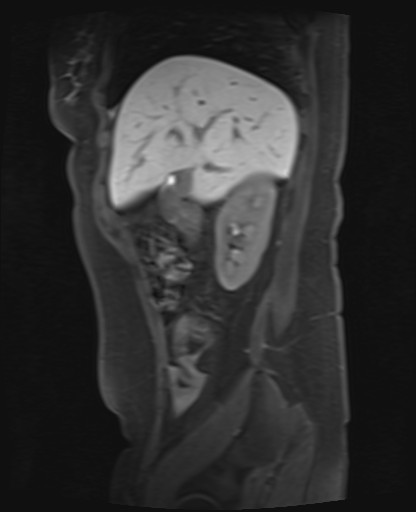 File:Normal hepatobiliary phase liver MRI (Radiopaedia 58968-66230 C 21).jpg