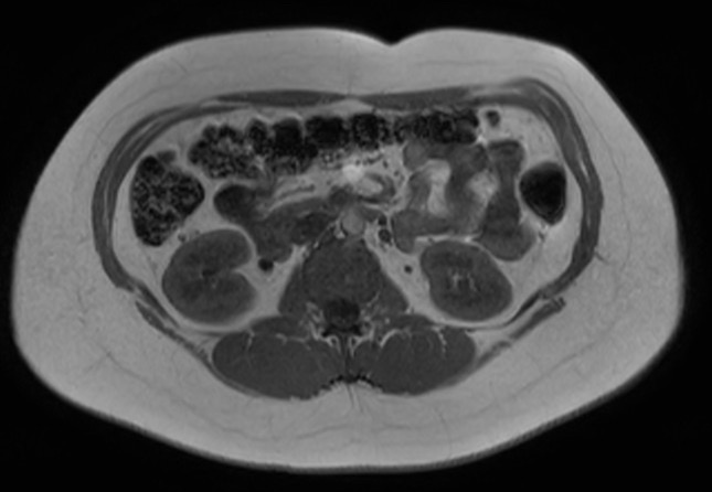 File:Normal liver MRI with Gadolinium (Radiopaedia 58913-66163 Axial T1 in-phase 10).jpg