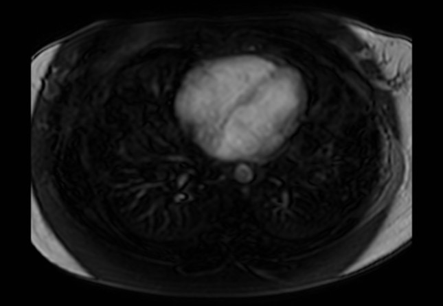 Normal liver MRI with Gadolinium (Radiopaedia 58913-66163 J 81).jpg