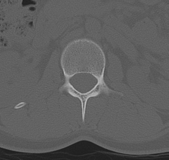 File:Normal lumbar spine CT (Radiopaedia 46533-50986 Axial bone window 13).png