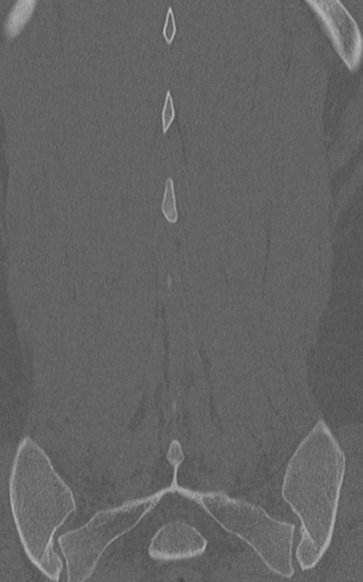 Normal lumbar spine CT (Radiopaedia 46533-50986 Coronal bone window 68).png