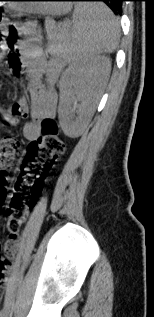 Normal lumbosacral CT (Radiopaedia 37923-39867 E 15).png