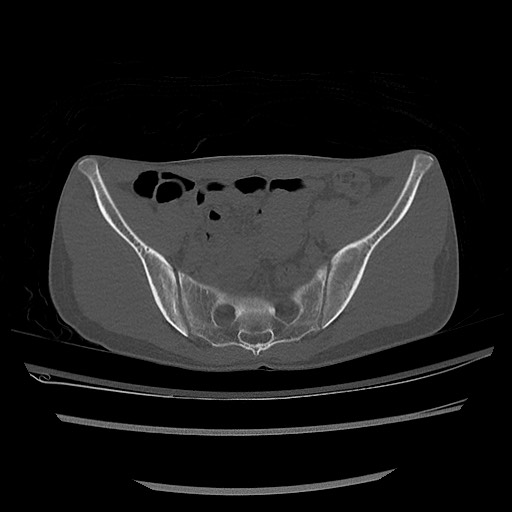 Normal pelvis CT (Radiopaedia 51471-57236 Axial bone window 39).jpg