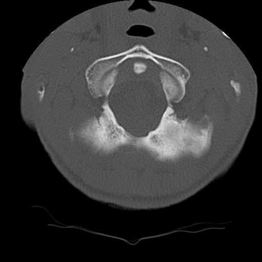 File:Normal trauma spine imaging (age 16) (Radiopaedia 45335-49358 Axial bone window 7).jpg