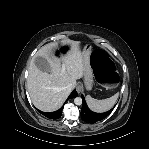 Obstructing sigmoid adenocarcinoma (Radiopaedia 58465-65619 A 31).jpg