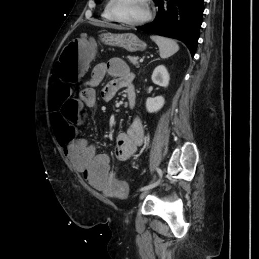 Obstructive colonic diverticular stricture (Radiopaedia 81085-94675 C 150).jpg
