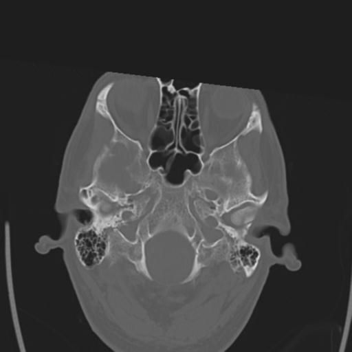 File:Obstructive hydrocephalus (Radiopaedia 30453-31119 Axial bone window 27).jpg