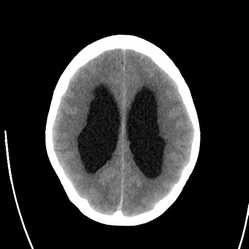File:Obstructive hydrocephalus (Radiopaedia 30453-31119 Axial non-contrast 19).jpg