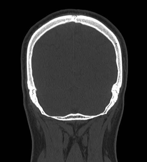 Occipital spur and Currarino type A atlas anomaly (Radiopaedia 87027-103285 Coronal bone window 118).jpg