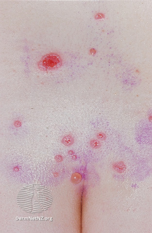 File:Pemphigus vulgaris (DermNet NZ immune-pgus5).jpg