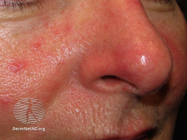 Rosacea (DermNet NZ acne-red-face-3628).jpg