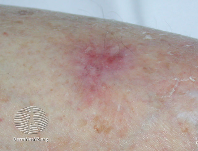 File:Superficial basal cell carcinoma, leg (DermNet NZ sbcc-leg-21-dn).jpg