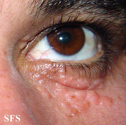 File:Syringoma (Dermatology Atlas 12).jpg