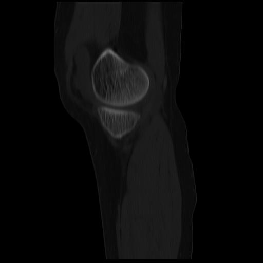 File:ACL avulsion fracture (Radiopaedia 33833-34994 Sagittal bone window 35).jpg
