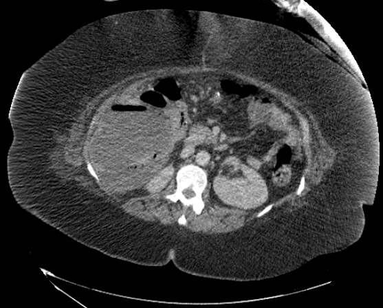 File:Abdominal abscess - pre and post percutaneous drainage (Radiopaedia 60209-67816 Axial 27).png
