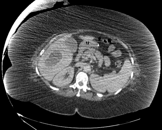File:Abdominal abscess - pre and post percutaneous drainage (Radiopaedia 60209-67816 Axial 53).png