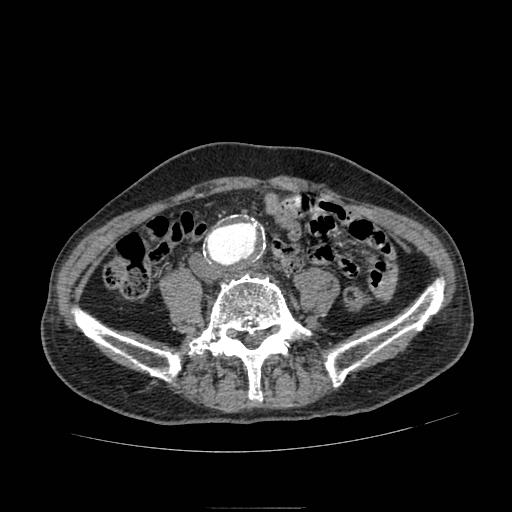 Abdominal aortic aneurysm (Radiopaedia 13341-13340 Axial C+ arterial phase 148).jpg