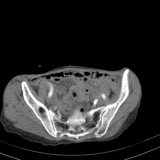 File:Abdominal aortic aneurysm (Radiopaedia 20827-20742 Axial C+ arterial phase 30).jpg