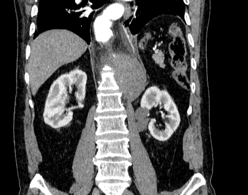 File:Abdominal aortic aneurysm (Radiopaedia 67117-76452 Coronal C+ arterial phase 67).jpg