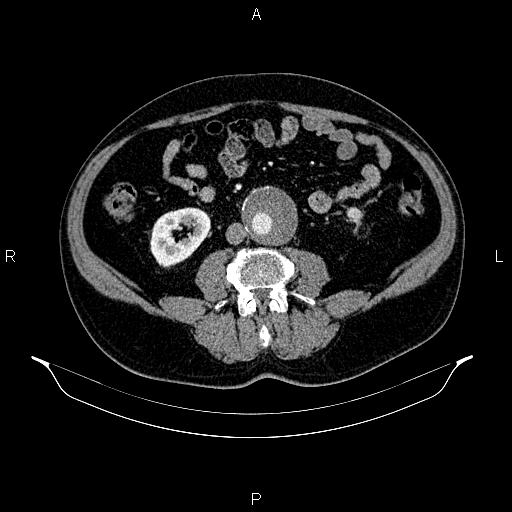 Abdominal aortic aneurysm (Radiopaedia 83094-97462 Axial renal cortical phase 109).jpg
