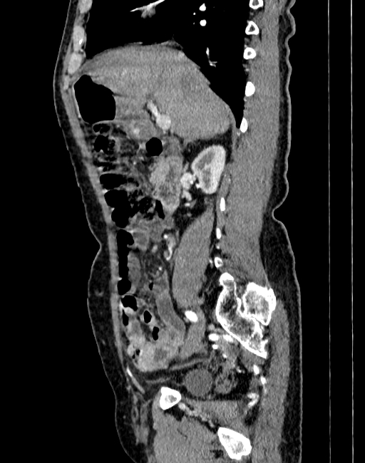 Abdominal aortic aneurysm (Radiopaedia 83581-98689 Sagittal C+ arterial phase 14).jpg