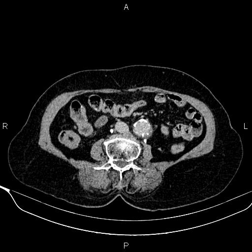 Abdominal aortic aneurysm (Radiopaedia 85063-100606 Axial C+ delayed 68).jpg