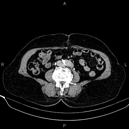 Abdominal aortic aneurysm (Radiopaedia 85063-100606 Axial C+ delayed 76).jpg