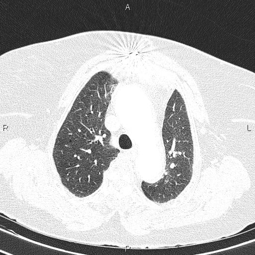 File:Abdominal aortic aneurysm (Radiopaedia 85063-100606 Axial lung window 23).jpg