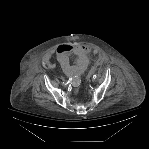 Abdominal aortic aneurysm - impending rupture (Radiopaedia 19233-19247 Axial non-contrast 132).jpg