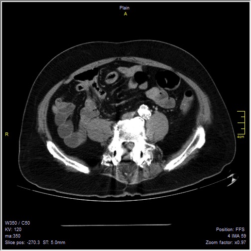 Abdominal aortic aneurysm with thrombus fissuration (Radiopaedia 47340-51926 Axial C+ arterial phase 43).jpg