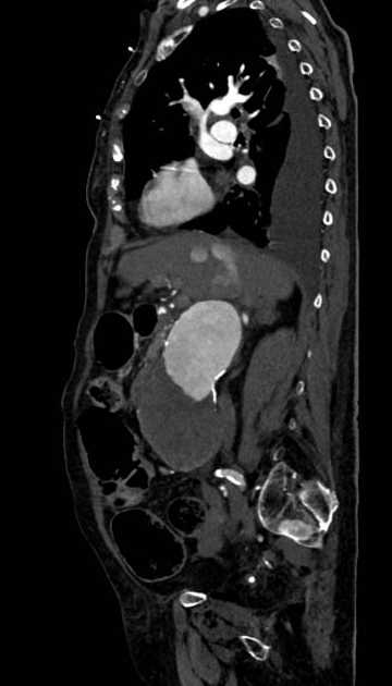 Abdominal aortic aneurysm with thrombus fissuration (Radiopaedia 73192-83919 Sagittal C+ arterial phase 87).jpg