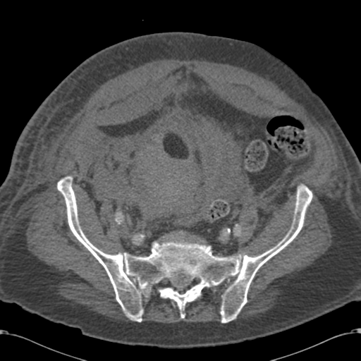 Abdominal hematoma (Radiopaedia 33614-34715 Axial C+ portal venous phase 96).png