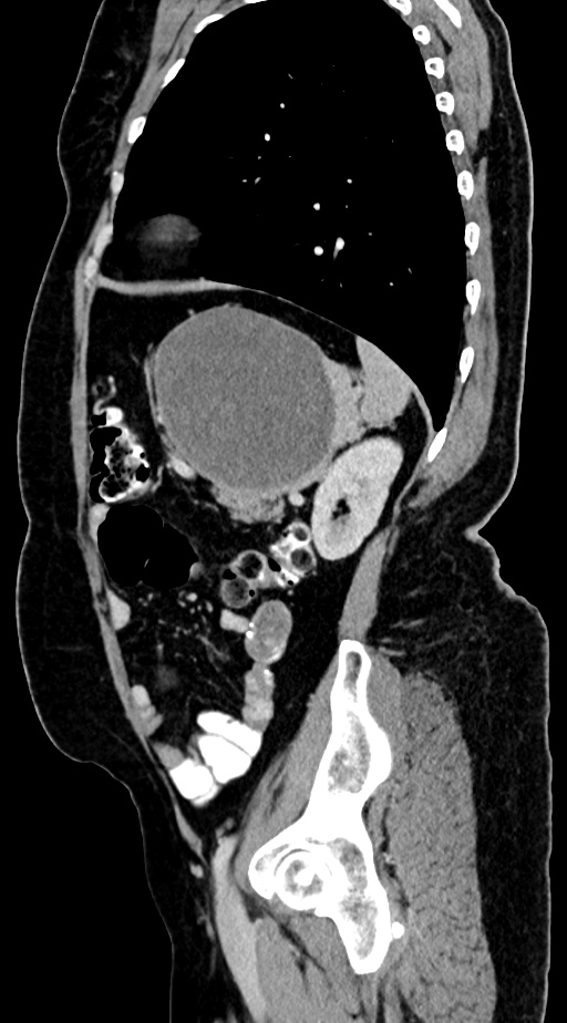 Abdominal hydatid disease (Radiopaedia 68223-77737 Sagittal C+ portal venous phase 19).jpg