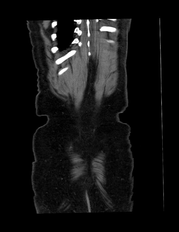 Abdominal lymphoma - with sandwich sign (Radiopaedia 53486-59492 C+ portal venous phase 2).jpg