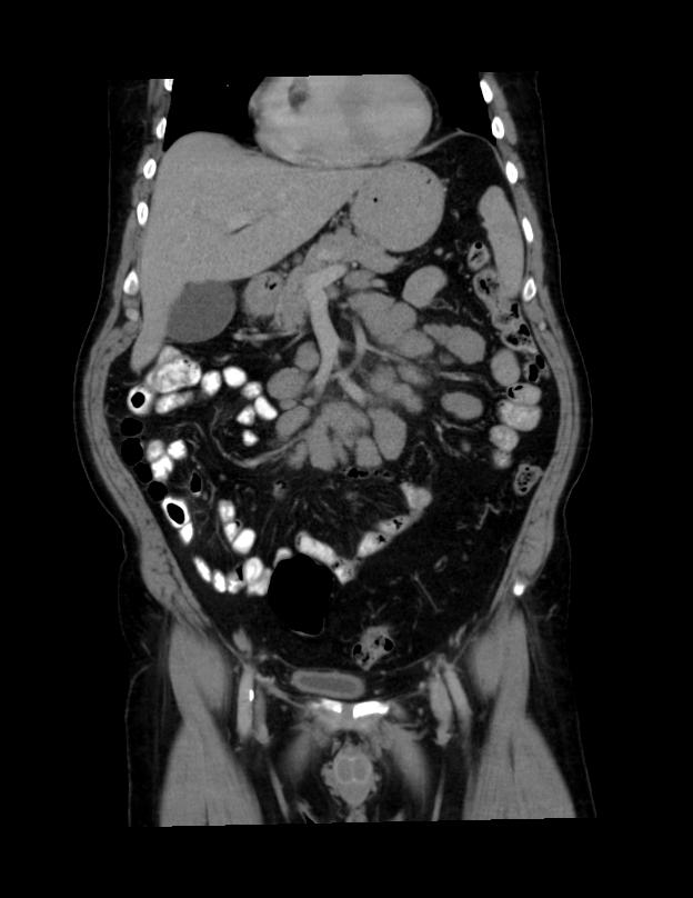 Abdominal lymphoma - with sandwich sign (Radiopaedia 53486-59492 C+ portal venous phase 38).jpg