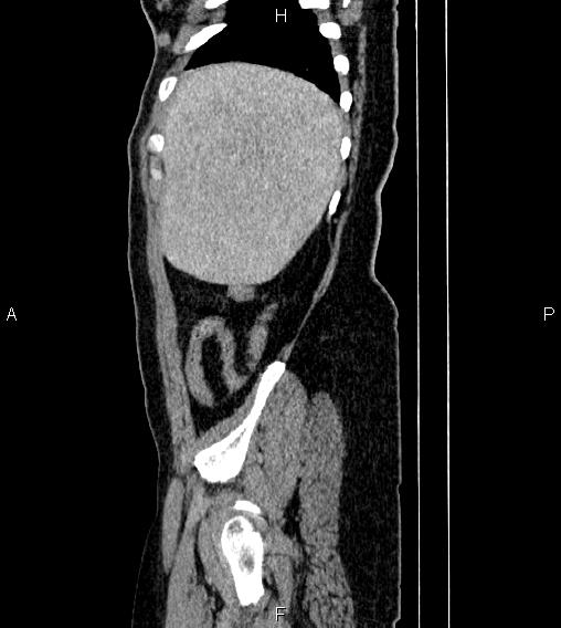 Abdominal lymphoma with sandwich sign (Radiopaedia 84378-99704 Sagittal C+ portal venous phase 81).jpg